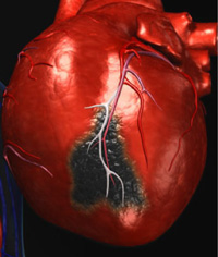 myocardial infarction