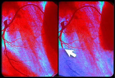 coronary angiogram