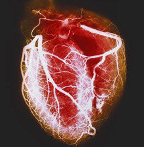 coronary angiogram